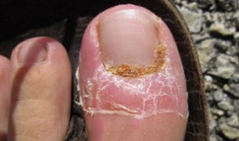 Третман на ноктите габа