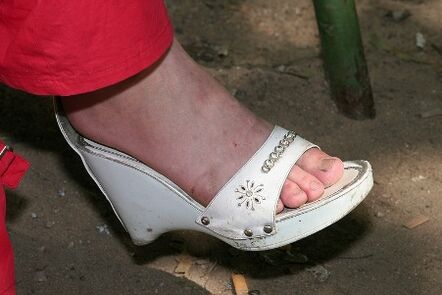 Недостаток на соодветна хигиена на стапалата е причина за развој на габа