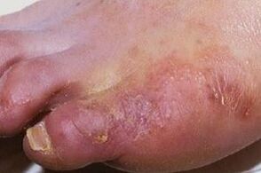 манифестации на габична инфекција на кожата на нозете