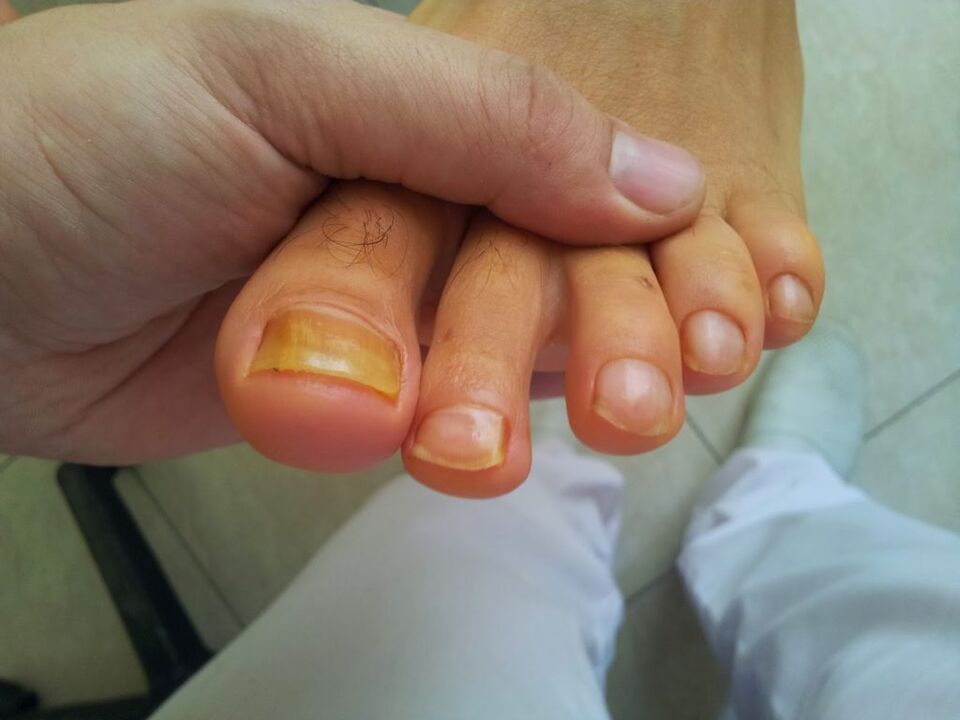пожолтување на ноктите на нозете со габа
