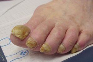 Симптоми на габа на ноктите на нозете