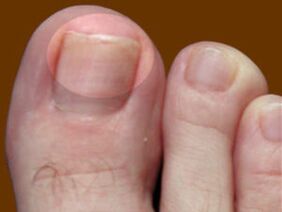 Габа на ноктите на нозете - индикација за употреба на фунгицидни капки