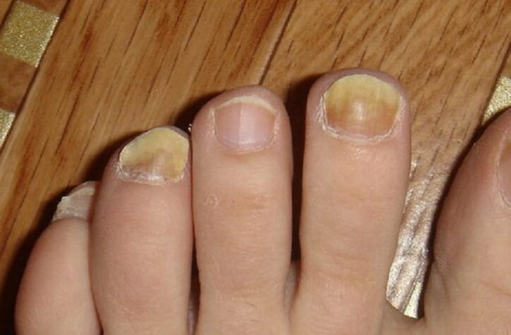 симптоми на габа на ноктите и кожата на стапалата