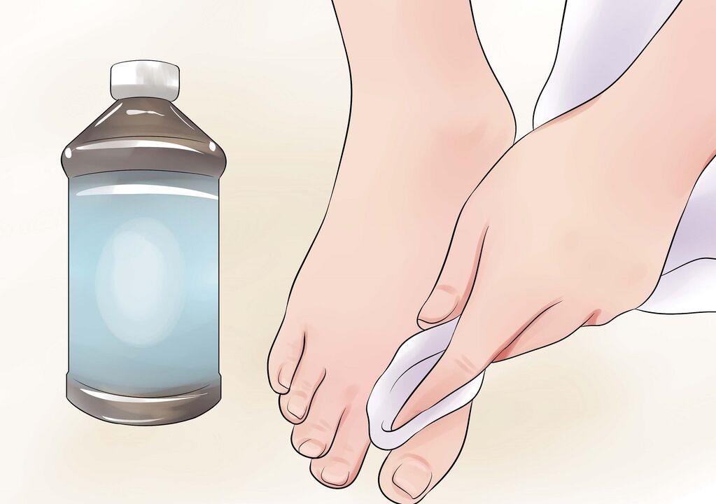 водород пероксид за габа на ноктите на нозете