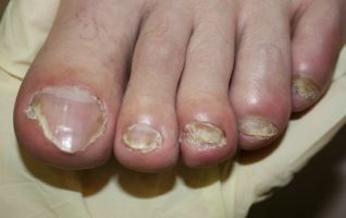 симптомите на ноктите габа